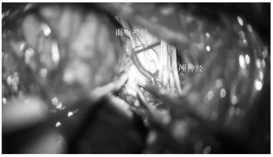 于面听神经根部及后组颅神经根部间造瘘，此处神经探头刺激阴性(牵开绒球)