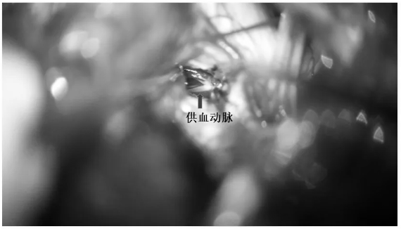 断除畸形血管团供血动脉