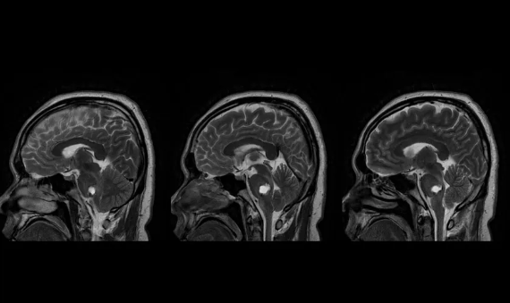 头颅MRI(术后24h)
