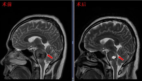 术后患者MRI显示面丘结构恢复