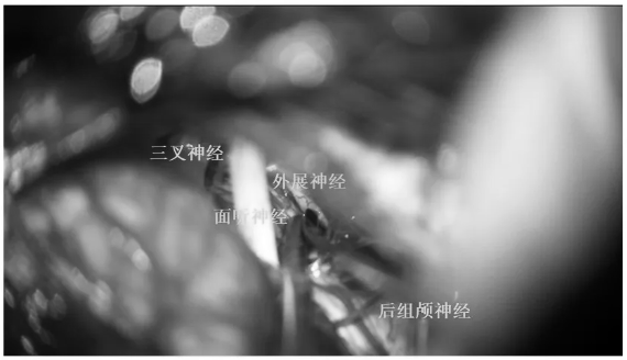 三叉神经、面听神经、外展神经、后组神经保护完好