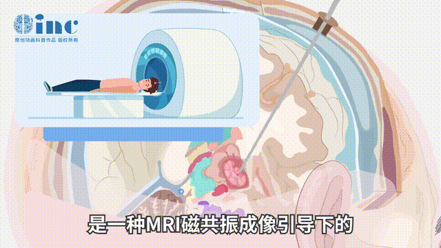 LITT 工作原理