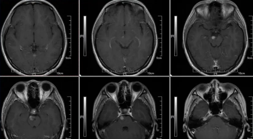 术前MRI T1W1 C+