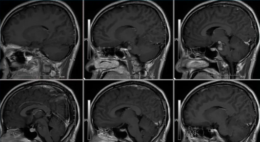 术前MRI T1W1 C+