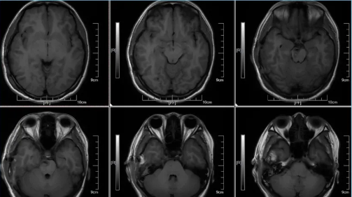 术后48h MRI T1W1