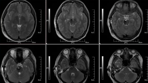 术后48h MRI T2W1