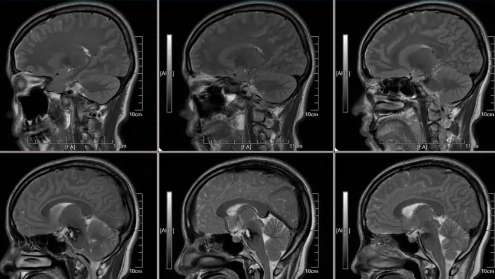 术后24内 MRI T2W1