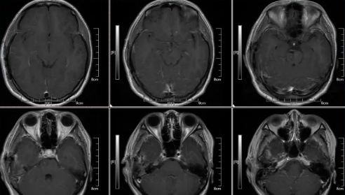 术后MRI T1W1 C+