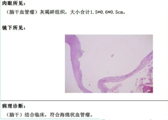 术后病理：脑干海绵状血管瘤