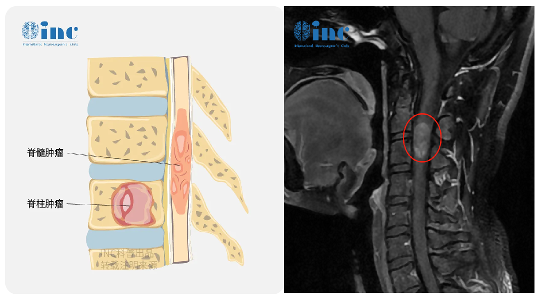 潇潇的脊髓MRI