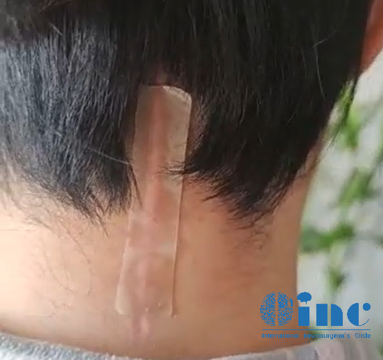 经历了脊髓髓内室管膜瘤全切术后的她状态良好，看起来几乎和常人无异，后脑勺那条细细的刀口被美丽的秀发覆盖着，别人都想象不到她曾经历过一场高难度的开颅手术。