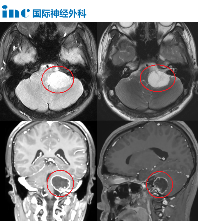 CPA区和颈静脉孔区位置长了一个不小的肿瘤