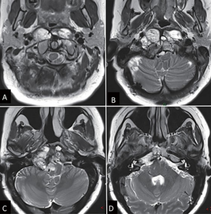 内镜下鼻内镜入路前的术前影像。(A - D) MRI T2 WI显示一个巨大脊索瘤延伸至椎前间隙和齿状突周围。肿瘤横向延伸至舌下管和颈静脉孔，并向内侧延伸至硬膜内间隙。肿瘤从斜坡中部延伸至枢椎齿状突周围。