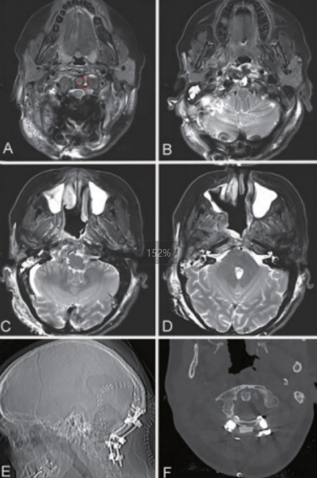 第二阶段远外侧入路开颅肿瘤切除术后影像学表现。（A-D）MRI T2 WI显示整个分期手术的脊索瘤完全切除，在发现轻微的残留肿瘤（A图红色圆圈）。该患者随后接受了质子治疗。X偏（E）和CT（F）检查显示经后路手术椎体固定稳定。