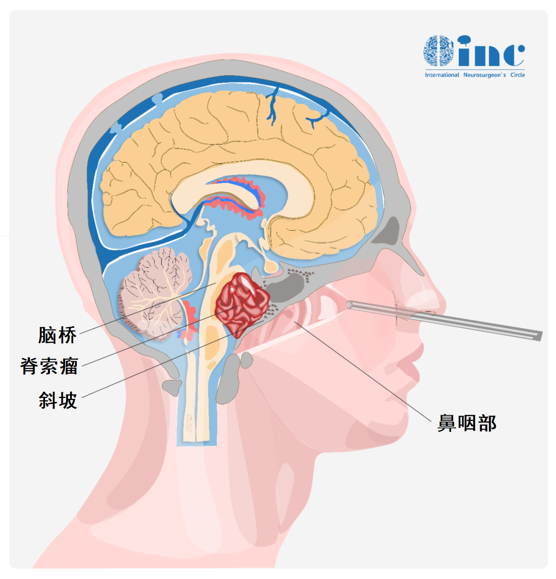 医生，从我的鼻孔真的可以取出“土豆”大的脑瘤吗？