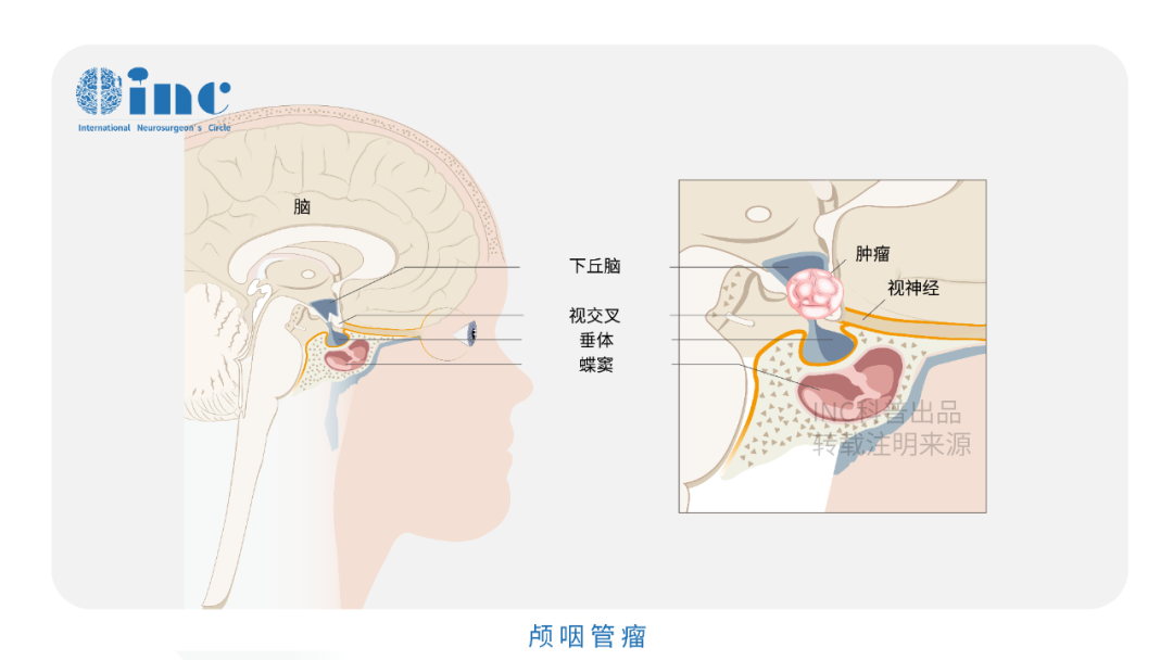 颅咽管瘤手术5大热点问题解读