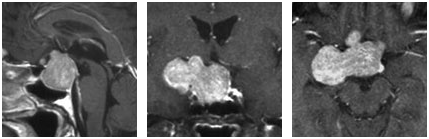 患者术前磁共振成像(MRI)影像
