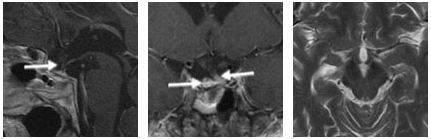 患者术后磁共振成像(MRI)影像