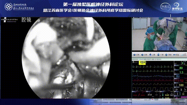 做好术野止血，注意延髓表面大动脉及其分支处理及保护。