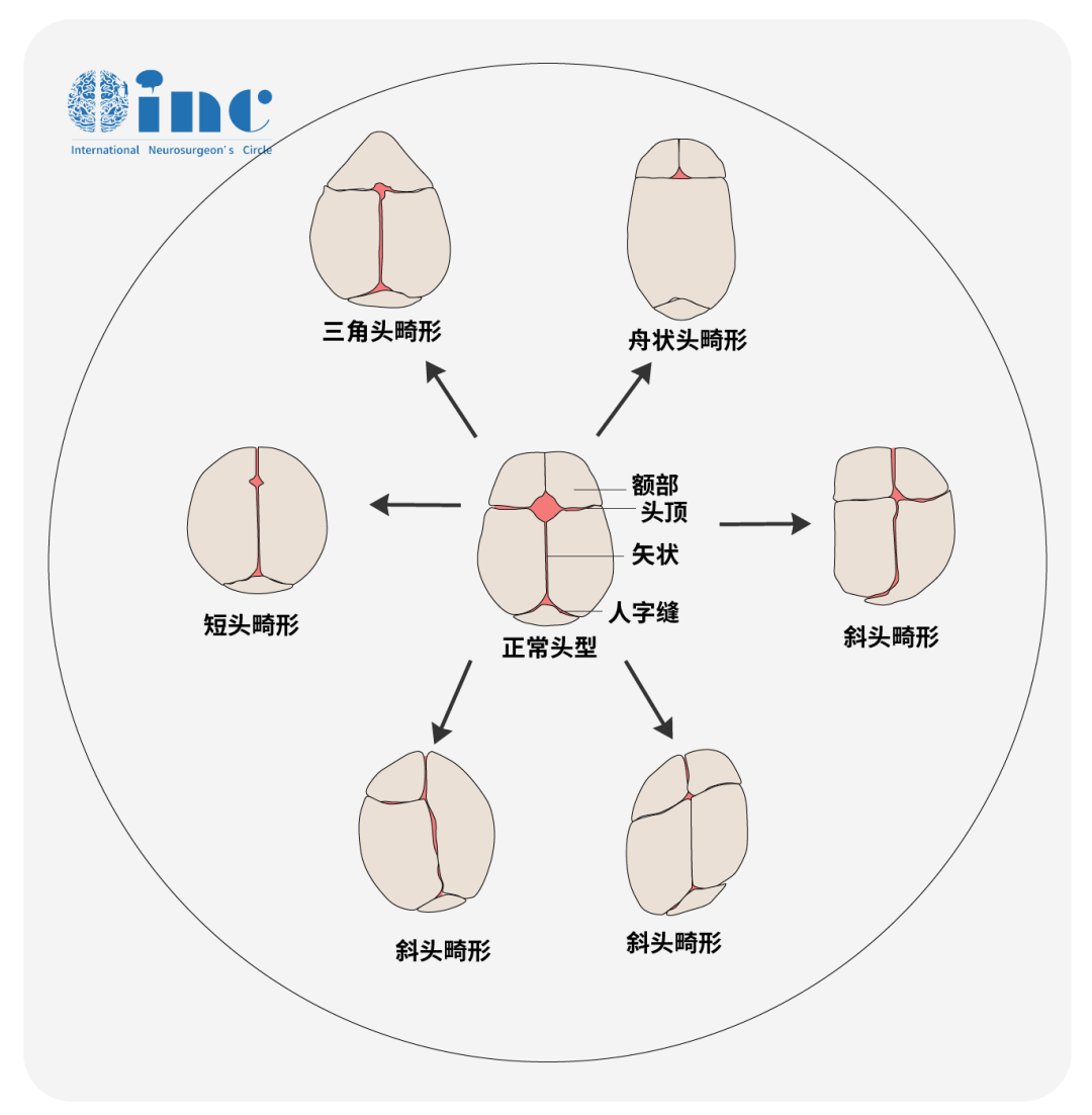 颅缝早闭的早期发现主要基于异常头型的主观识别