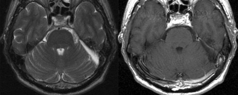 术后 MRI 图像显示肿瘤已完全切除