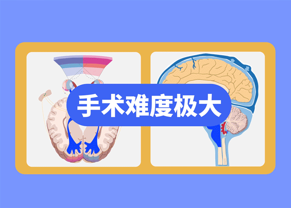 毛细胞型星形细胞瘤