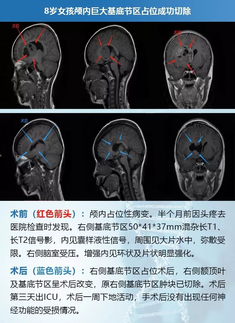 INC巴教授主刀手术后