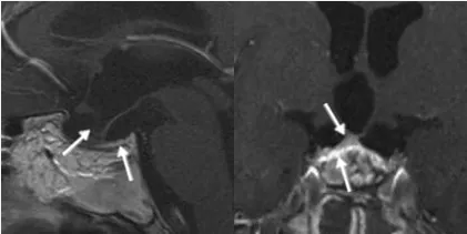术后进行的磁共振成像（MRI）随访检查表明肿瘤已被完全切除，同时显示剩余的垂体腺明显萎缩但仍保持完整。
