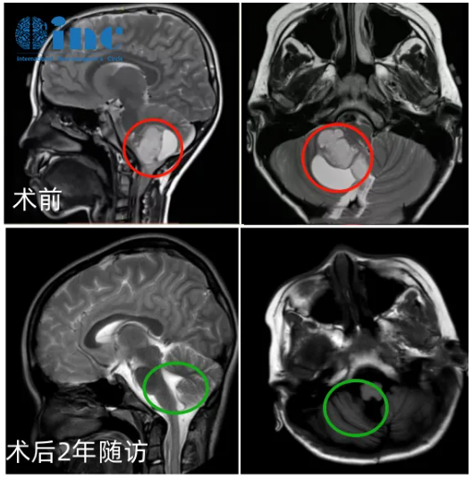 术后两年随访影像