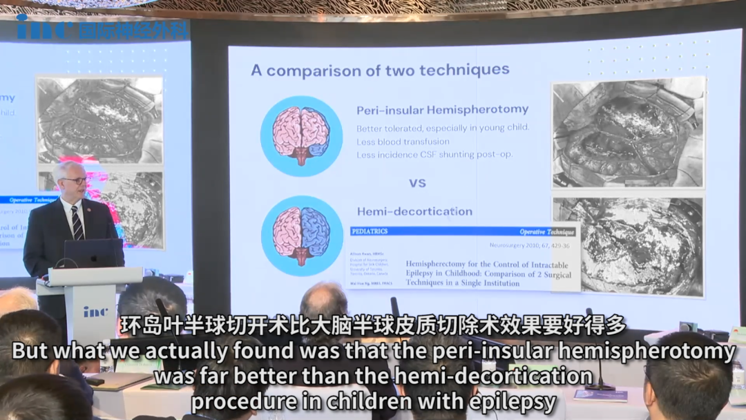 “我曾为两个月大或更小的孩子做过大脑半球切除术，这非常具有挑战性。过去50年来，我们已经从过去极具创伤性的手术——也就是解剖性大脑半球切除术——发展到了更加微创性的手术。作为参考，我主要做的是外侧裂周围功能性大脑半球切开术，但最近我们在（多伦多）SickKids儿童医院做了垂直大脑半球切开术。”