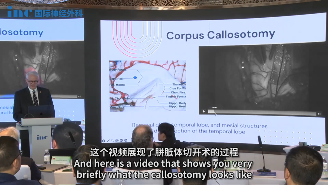 　　这里是室间孔，可以在这里找到胼胝体周围血管，在室间孔上方约 1 厘米处，即穹窿上方。这个视频展现了胼胝体切开术的过程。