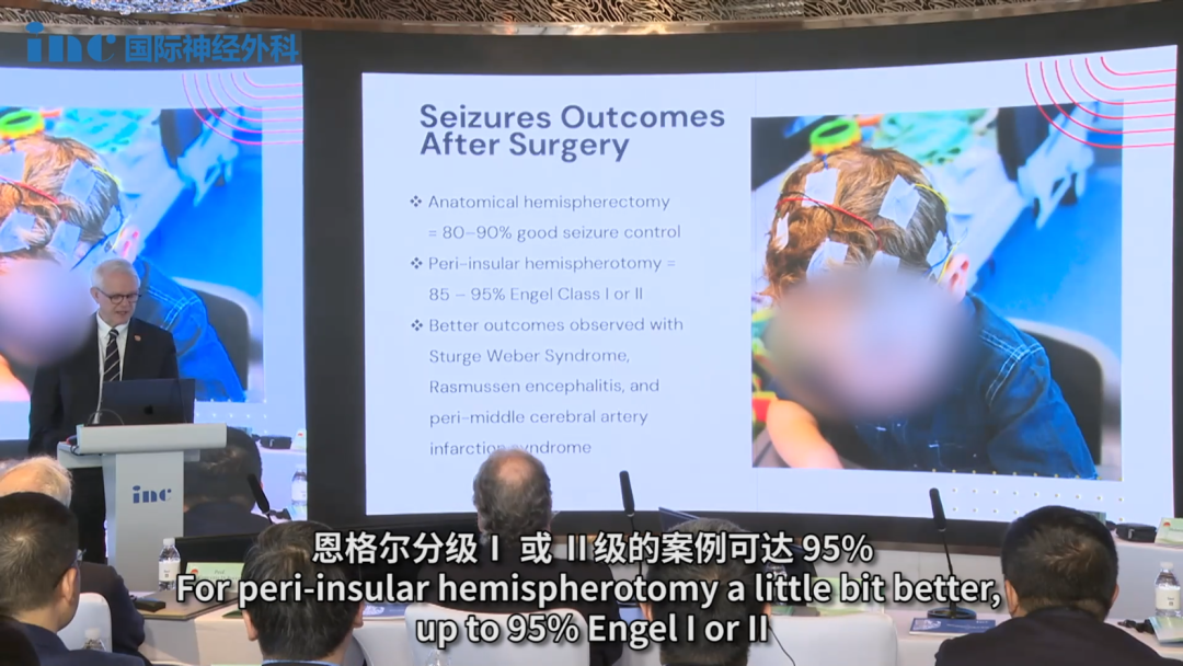 Rutka教授特别指出：“解剖大脑半球切除术的癫痫发作预后良好率约为 80%-90%。对于环岛叶半球切开术的癫痫发作预后良好率会稍微好一些，恩格尔分级Ⅰ 或 Ⅱ级的案例可达 95%。而 Sturge-Weber 综合征、Rasmussen脑炎和大脑中动脉周围梗塞综合征的治疗效果更好。”