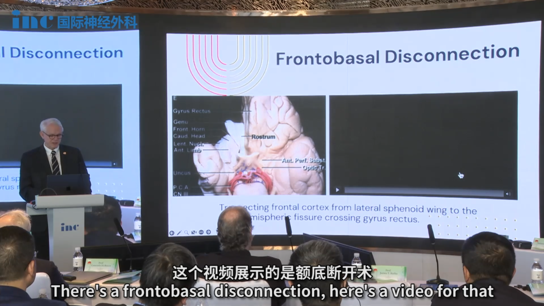 这个视频展示的是额底断开术，基本上是穿过胼胝体嘴部进入扣带回区域，并在外侧面从蝶骨翼进入。再加上胼胝体切开术，我们就能完全切断额叶与大脑其他部分的联系。