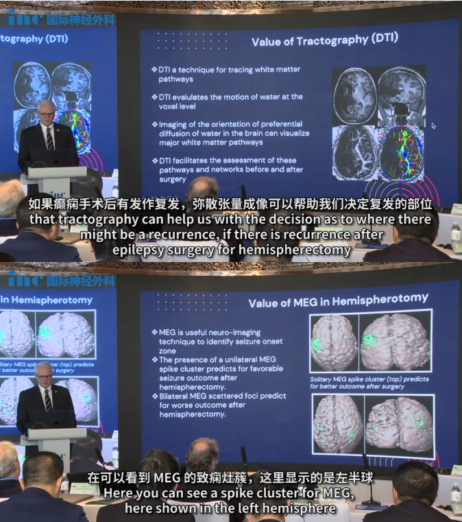 MEG（脑磁图）对这种情况也非常重要，它可以帮助预测哪些患儿的半球切除术后效果良好。