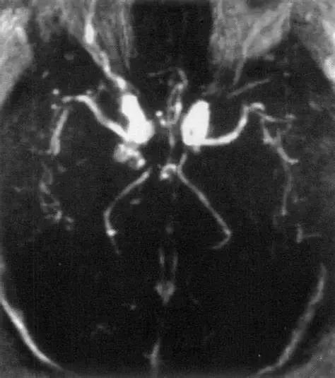 海绵窦动静脉瘘(Carotid-Cavernous Fistula, CCF)