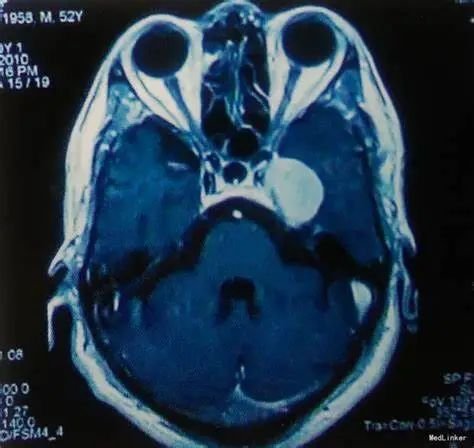海绵窦区脑膜瘤（Meningiomas）