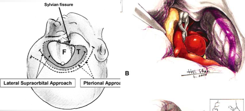 专题一：Lateral Supraorbital Approach for Aneurysmal Clipping