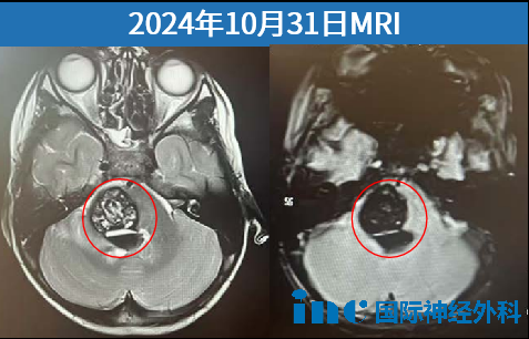 大出血伴随病灶周围压力剧增与水肿蔓延，水肿自延髓迅速扩展至中脑。