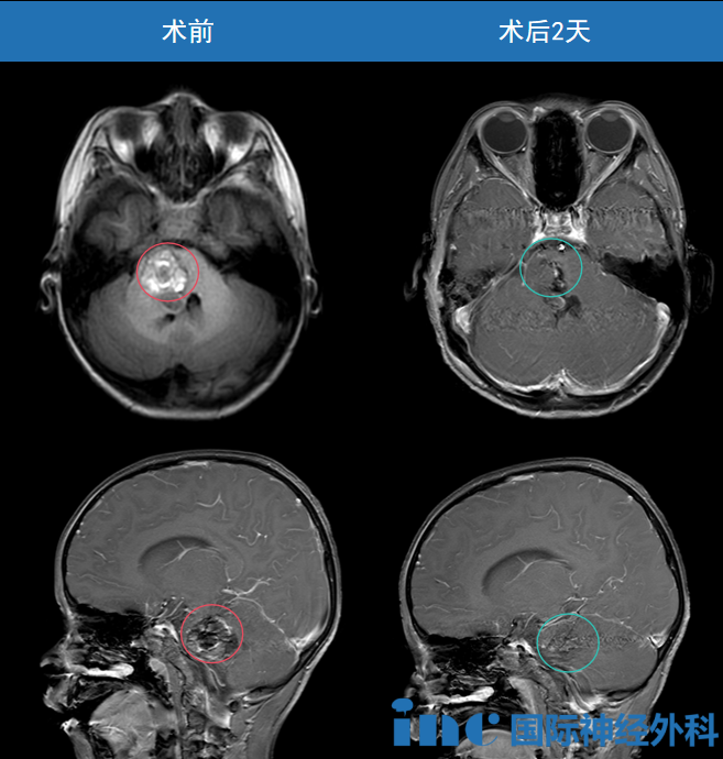 这颗巨大的脑干海绵状血管瘤被顺利全切。