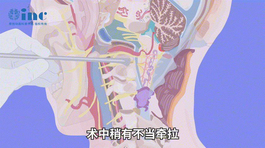 一旦这条“蛇”侵袭到高颈髓，或者肿瘤突然“爆发”，患者的病情就会急剧恶化，生命也可能因此受到威胁。