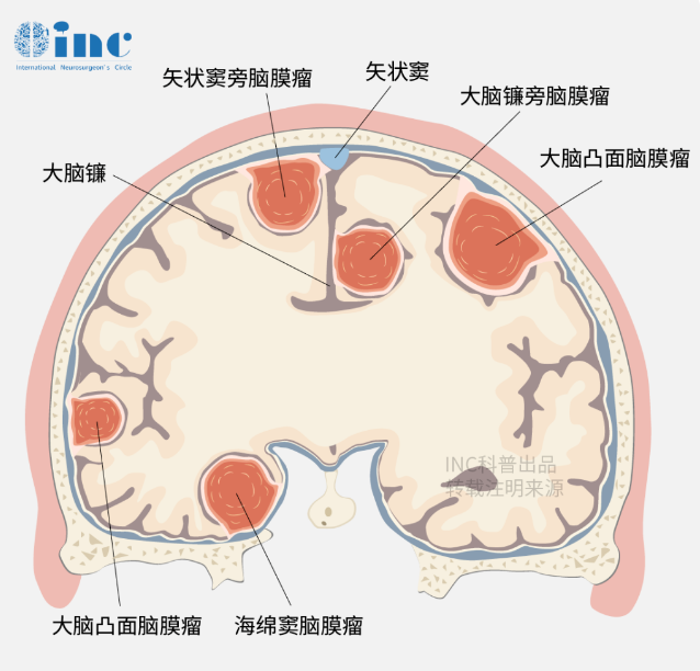 嗅沟脑膜瘤