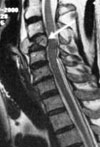 磁共振成像(MRI)结果显示了脊髓受到压迫的现象。