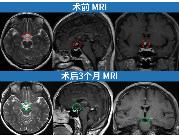 术前术后影像