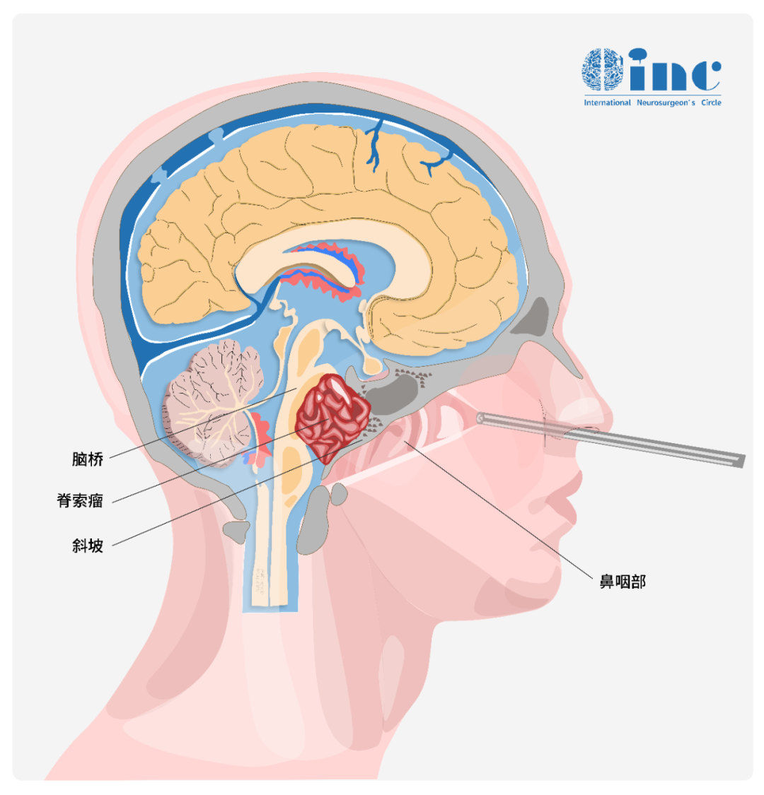 斜坡是颅底的一个重要解剖区域，它包含多个关键的神经组织和结构，包括：