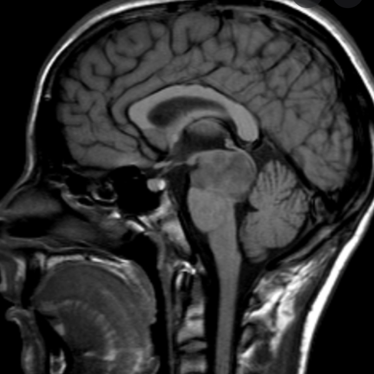 中脑被盖胶质瘤，以腹部被盖生长肿瘤，嗜睡、动眼神经麻痹、视物模糊等明显，无明显边界，手术难度大，预后差。
