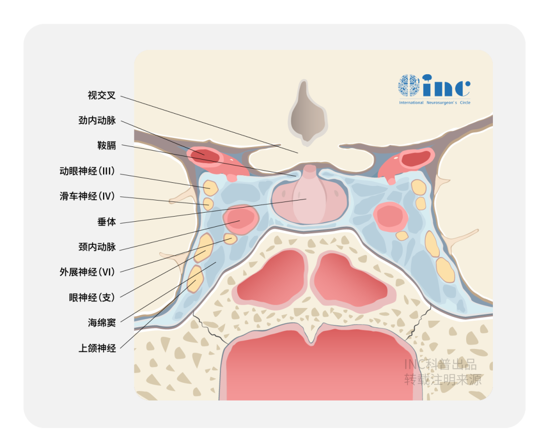 不请自来的海绵窦侵袭者，INC大咖施罗德教授“双镜联合”全切垂体瘤