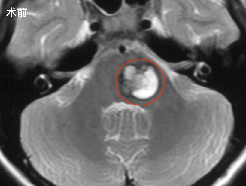 视物重影、肢体无力，学霸不幸患脑干肿瘤伴脑干出血，这难题怎解？
