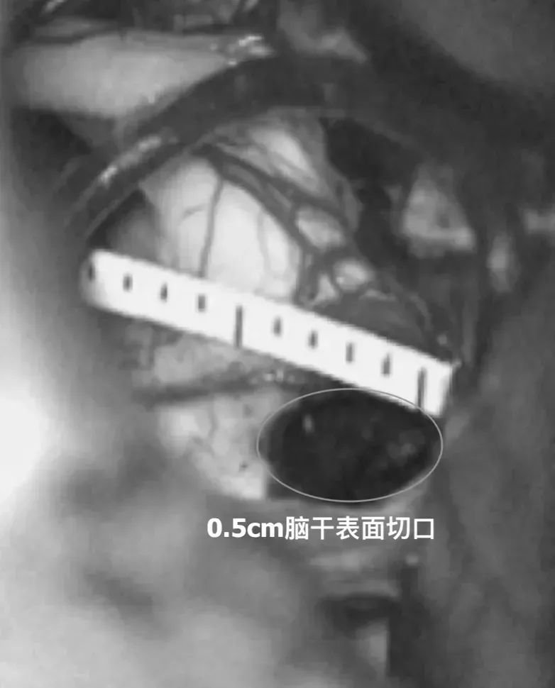 图：全切病变后，直尺测量经脑干切除病变切口为3cm