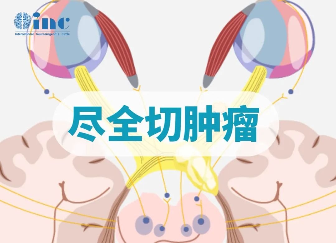 INC国际大咖经蝶窦手术让垂体大腺瘤无处可逃