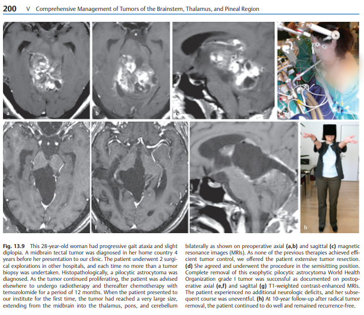该案例发表于：2020年的脑干肿瘤手术经典专著《Surgery of the Brainstem》中第13章Adult Brainstem Gliomas(成人脑干胶质瘤)。